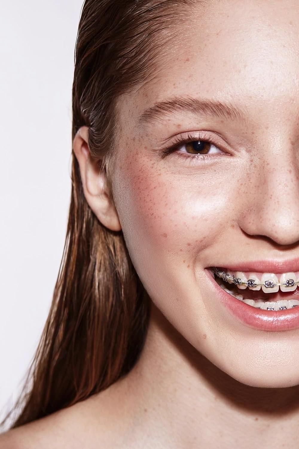 Исправление прикуса в True Dent