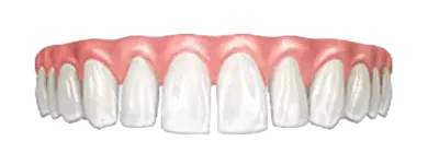 Щели между зубов