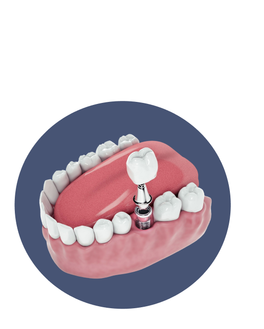 Имплантация DL Med